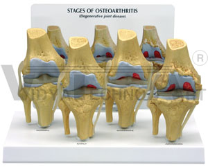 4-Stage Osteoarthritis Knee